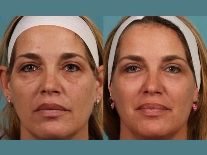 Chemical Peel