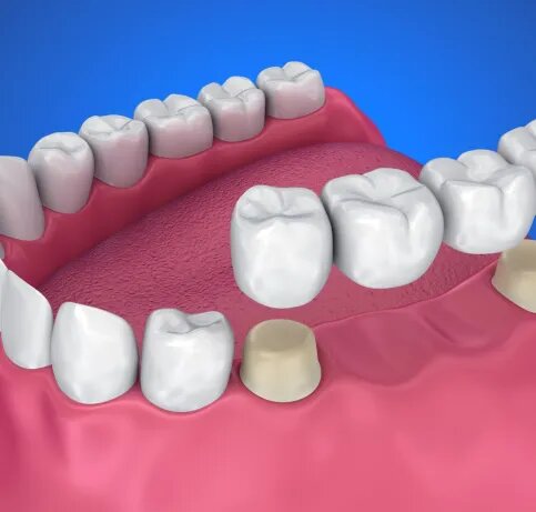 dental bridge service