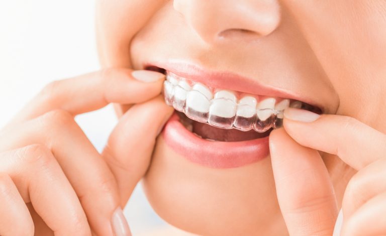 Invisalign Braces Dubai – Straighten Your Teeth the Invisible Way
