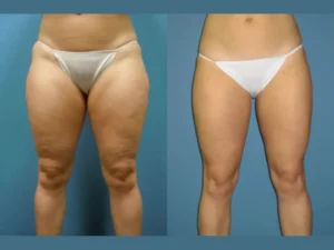 Radiofrequency (RF) Microneedling in Dubai