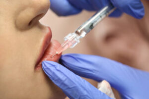 Lip Filler Injection in Dubai