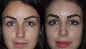 Rhinoplasty in Dubai