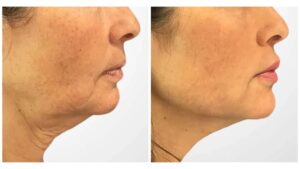 Achieve Firmer, Tighter Skin Quickly with Thread Lift Treatment in Dubai
