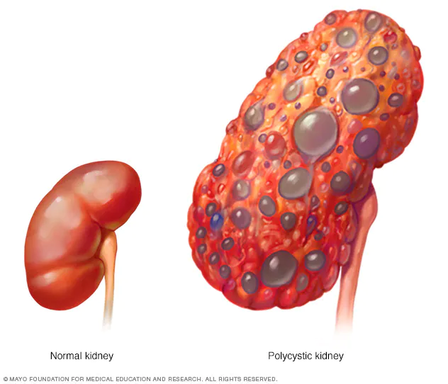 Kidney Issues