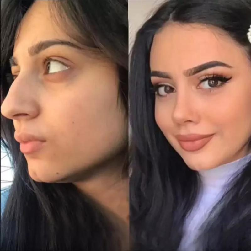 Rhinoplasty Before and After Visualizing the Transformation in Dubai