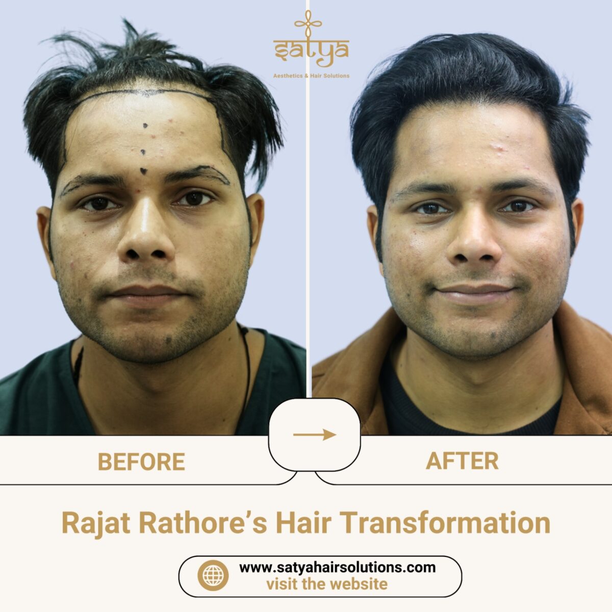 BEST HAIR TRANSPLANT CLINIC IN DELHI NCR