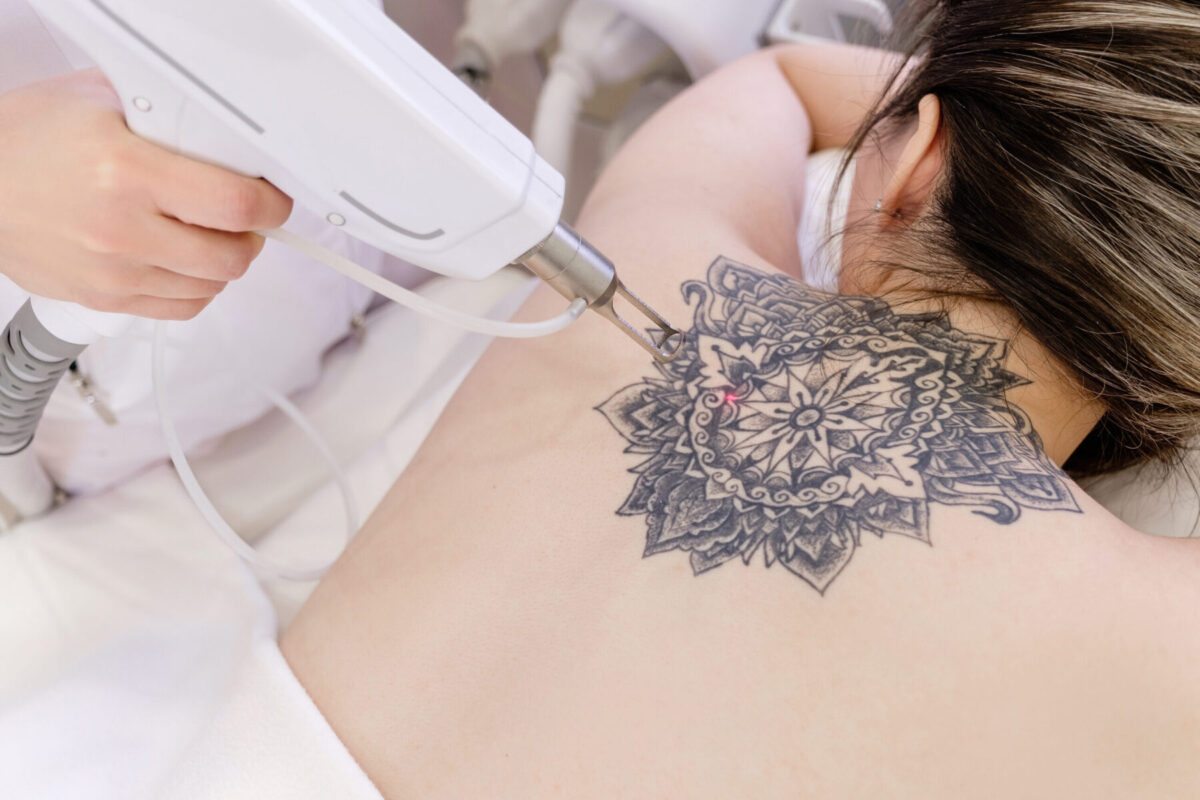 Laser Tatoo Removal