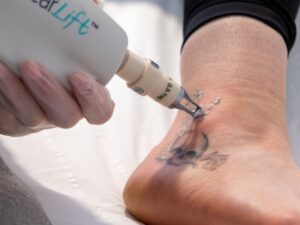 Laser Tatoo Removal