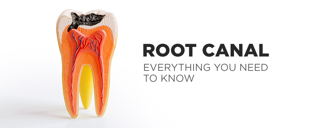 Understanding Root Canal Treatment: What You Need to Know