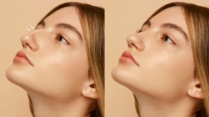 Rhinoplasty success rate in pakistan