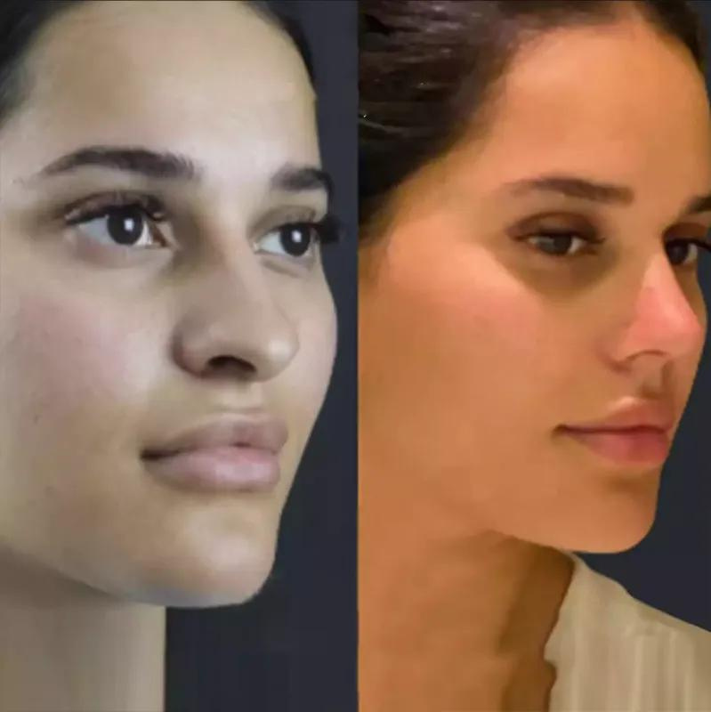 The Ultimate List of the Best Rhinoplasty Surgeons in Dubai for 2024