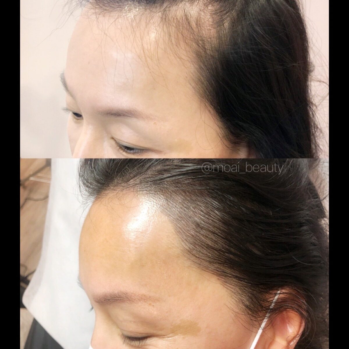 scalp micropigmentation for women