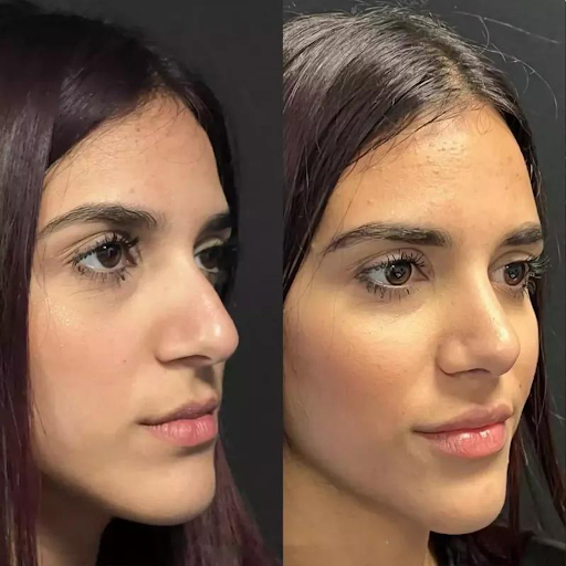 Why the Best Rhinoplasty Surgeon in Dubai Is Key to Exceptional Results