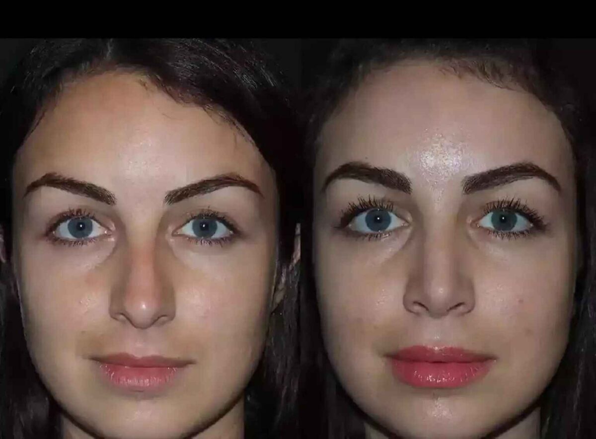 Rhinoplasty in Dubai