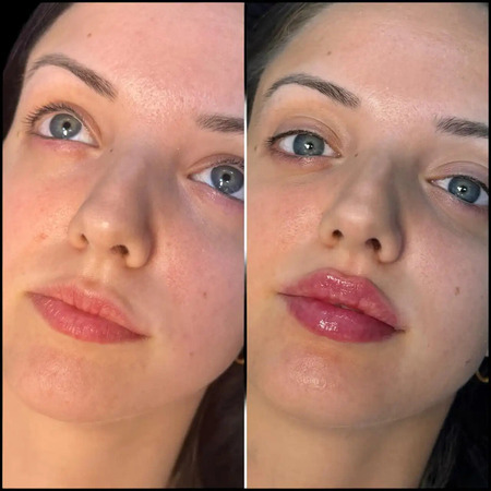 Hyacorp Fillers in dubai