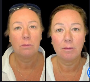 Non-surgical Facelift in Dubai: The Secret to Ageless Beauty