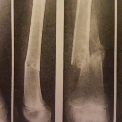 Advanced Bone Healing