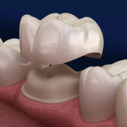 dental crown services