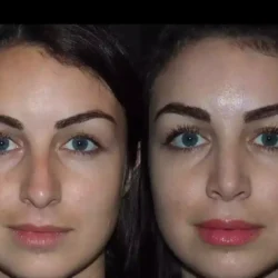 nose surgery in dubai