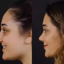 Septoplasty in Dubai