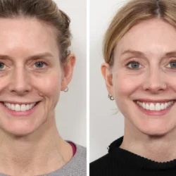 Best Aesthetic Clinic in Dubai: Thread Lift for Forehead Tightening