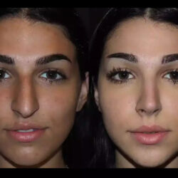 Septoplasty in Dubai