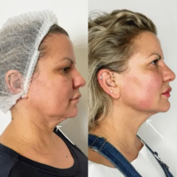 Restore Elasticity with Advanced Endolift Treatments in Dubai