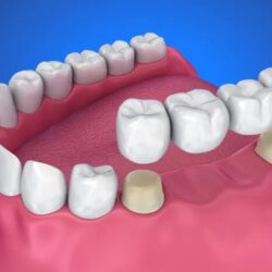 dental bridge service