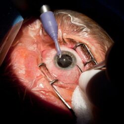 Everything You Need to Know About Cataract Surgery at Sobti Nursing Home