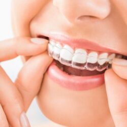 Invisalign Braces Dubai – Straighten Your Teeth the Invisible Way