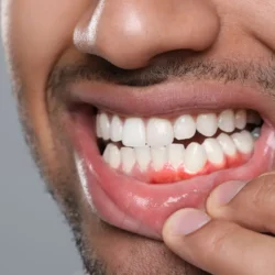 Fix Receding Gums