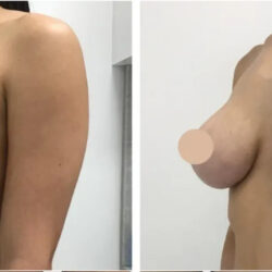 Breast Reduction in Dubai