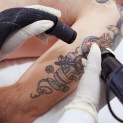 Tattoo Removal in Islamabad