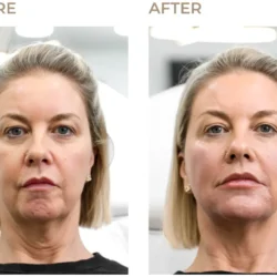 Sculptra In Manchester