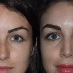 rhinoplasty in dubai