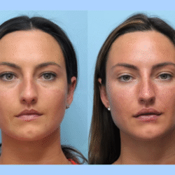 Thread Lift Treatment in Dubai: A Safe and Effective Anti-Aging Solution