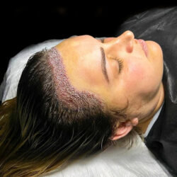 FUT hair transplant in Islamabad.