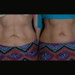 Skin Tightening treatment in Dubai