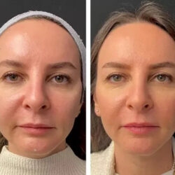 mesotherapy in Dubai