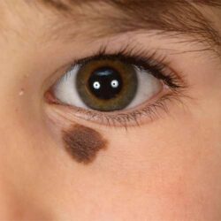 Precision treatment for skin birthmarks