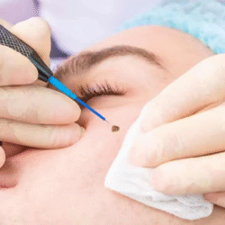 Quick and precise mole removal