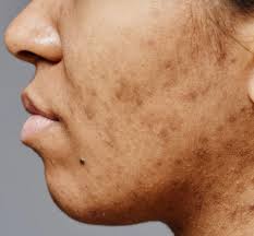 Restore skin’s natural brightness