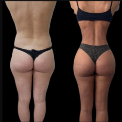 J-Plasma Skin Tightening Treatment In Dubai