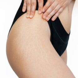 Stretch mark removal in Riyadh