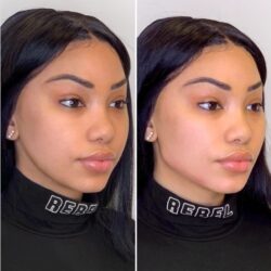 Transform Your Beauty Instantly with Advanced Thread Lift Treatment in Dubai