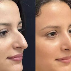 Rhinoplasty surgeons in Dubai