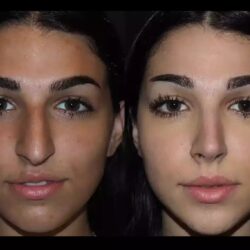 Rhinoplasty in Dubai