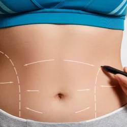 Transform Your Midsection with Abdominoplasty in Jeddah