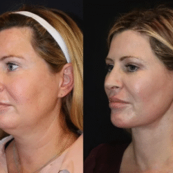 Skin Tightening Treatment in Dubai