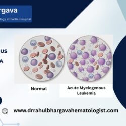 AML treatment in India